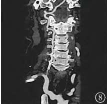 症状性颅外段椎动脉长节段闭塞复合手术一例