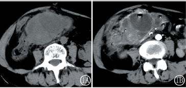 腹内型侵袭性纤维瘤病的病理及CT影像特征