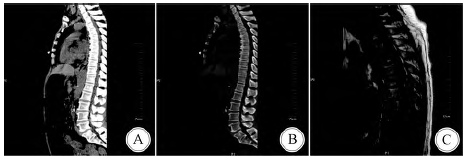 硬脊膜外脓肿4例