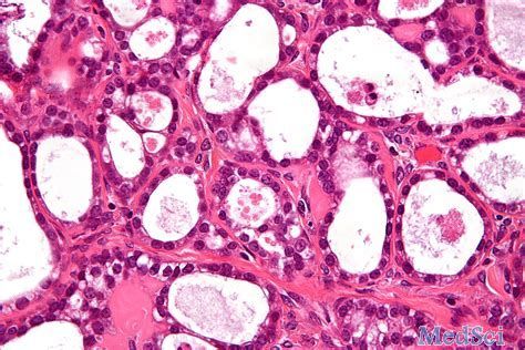 难治性晚期或复发性卵巢癌患者的III期试验：Opdivo（Nivolumab）未能改善总生存率