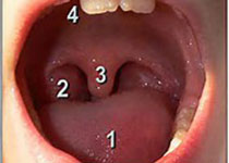J Endod：上颌第一磨牙尖周健康与上颌窦粘膜增厚之间的关系