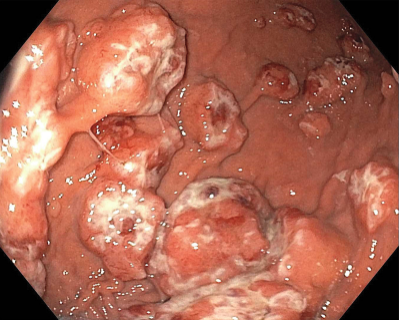 NEJM：转移性黑素瘤患者胃肠道出血-病例报道