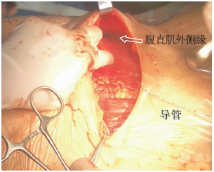 全麻剖宫产术中直视下腹横肌平面留置阻滞导管术后镇痛病例报道