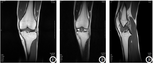 膝关节腔内良性纤维组织细胞瘤一例