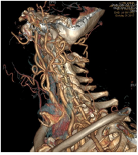 颈外动脉缺如并颈内动脉狭窄1例