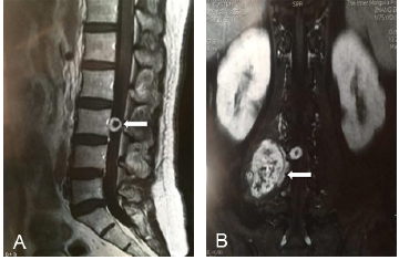 经前外侧腹膜后入路手术切除腰椎管巨大哑铃型肿瘤1例