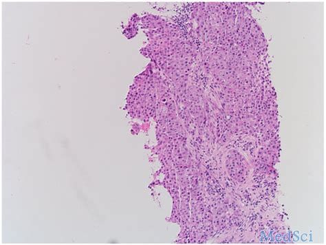 抗CD27激动剂<font color="red">MK</font>-5890治疗非小细胞肺癌