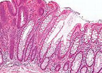 Cell Death Dis：RAI16在炎性肠病及结肠炎相关肿瘤发生过程中的作用