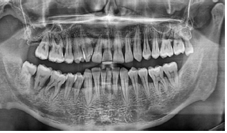 自体牙本质颗粒应用于牙周炎患牙拔除后即刻种植1例