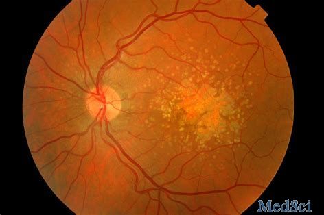 KSI-301治疗湿性AMD、糖尿病性黄斑水肿和视网膜静脉阻塞的Ib期临床试验取得积极结果