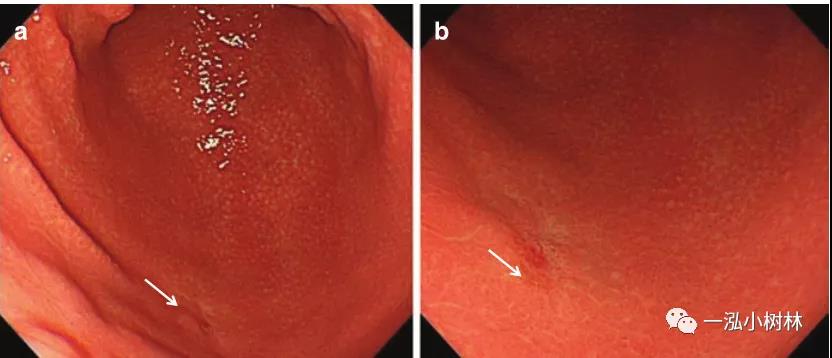 早期胃癌（未分化型、混合型及sig）内镜治疗策略