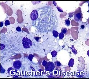 Gaucher病的AAV基因疗法取得新进展
