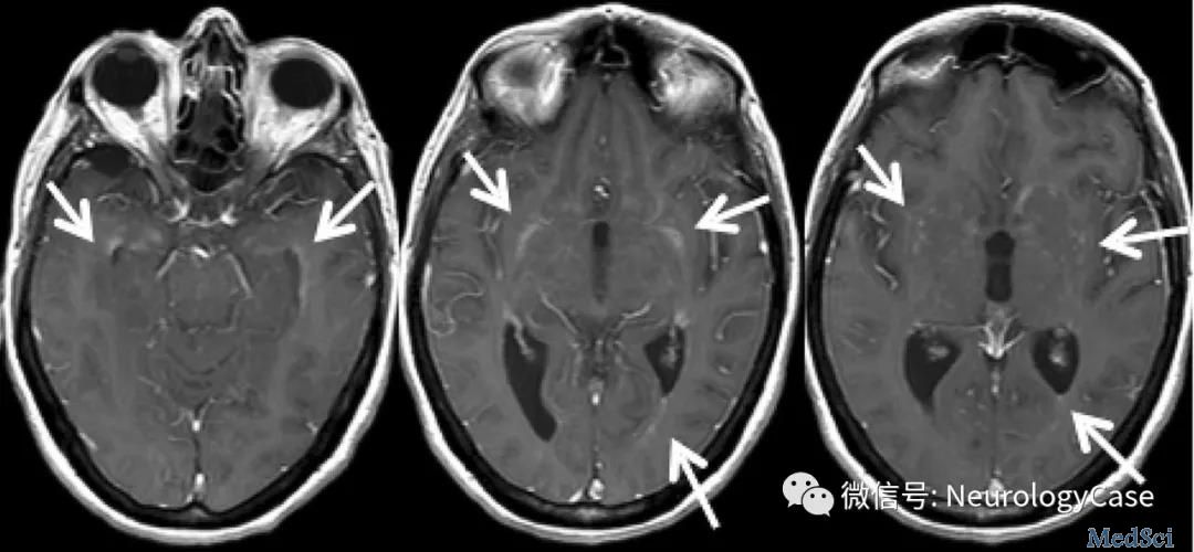 Neurology病例：自身免疫性胶质纤维酸性蛋白脑膜脑脊髓炎