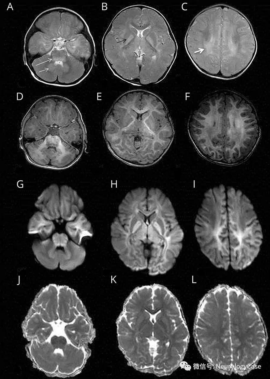 Neurology：病例：MRI可为发作性共济失调的诊断线索