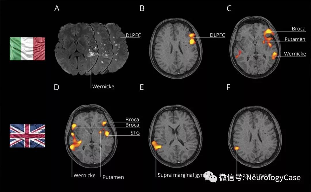 Neurology：功能MRI可洞察双语失语症的语言组织