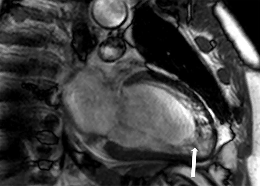 Neurology：心脏 MRI 在卒中病因诊断中的价值