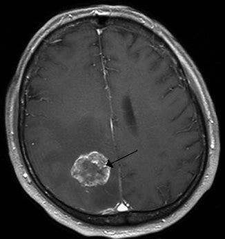 脑肿瘤一线治疗：VAL-083的II期临床试验即将开始
