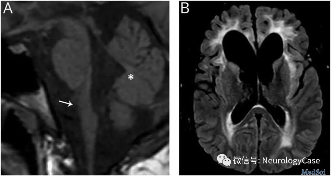Neurology：病例：见于脑白质营养不良的腭肌阵挛，指向亚历山大病的临床体征