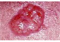 Lancet oncol：卡博<font color="red">替</font>尼用于高度恶性的尤文肉瘤和骨肉瘤的疗效和安全性