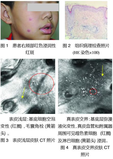 儿童面部局限型盘状红斑狼疮 1 例及反射式共聚 焦显微镜观察