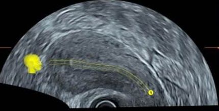 子宫内膜的薄厚对受孕影响大吗？