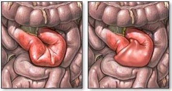 DCR：结肠减压可减少近端急性结肠假性梗阻及相关症状