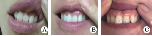 上前牙牙龈色素痣1例